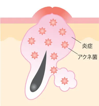 赤ニキビ（炎症ニキビ）