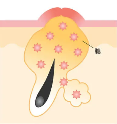 黄ニキビ（化膿ニキビ）