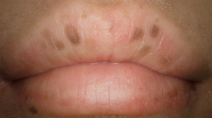 口唇シミ取り（Qスイッチレーザー）